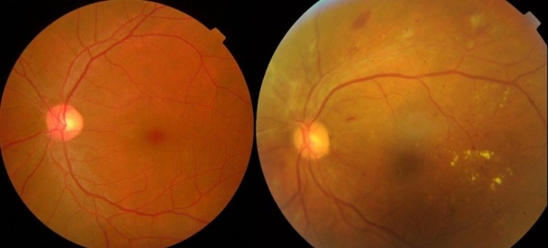 Training an algorithm to detect and prevent early blindness - EDN Asia